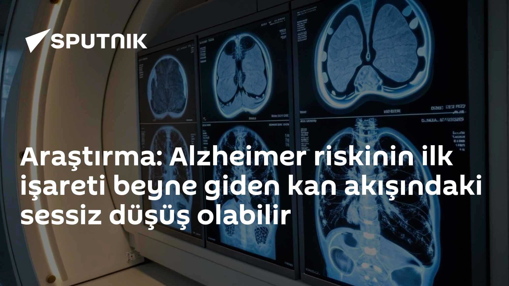 'Alzheimer Riskinin İlk İşaretleri Beyne Giden Kan Akışı Değişimleri' - Bugun.TR