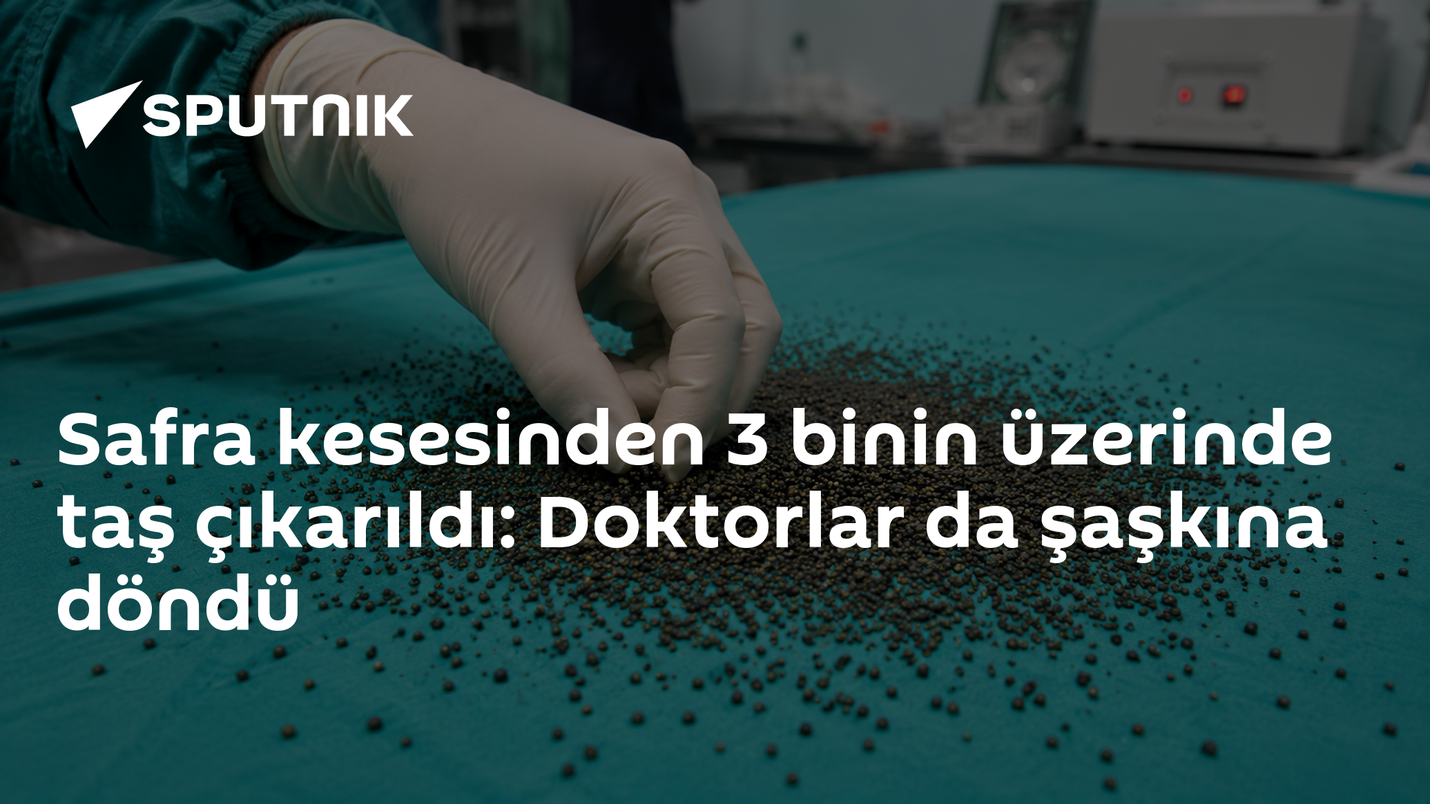 Safra kesesinden 3 binin üzerinde taş çıkarıldı: Doktorlar d