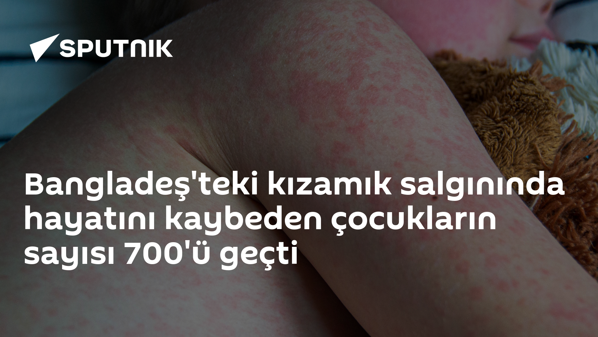 Bangladeş'teki kızamık salgınında hayatını kaybeden çocukların sayısı 700'ü geçti