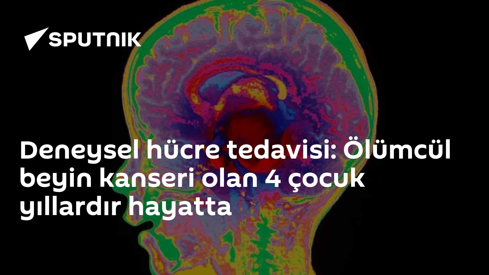 Deneysel hücre tedavisi: Ölümcül beyin kanseri olan 4 çocuk yıllardır hayatta