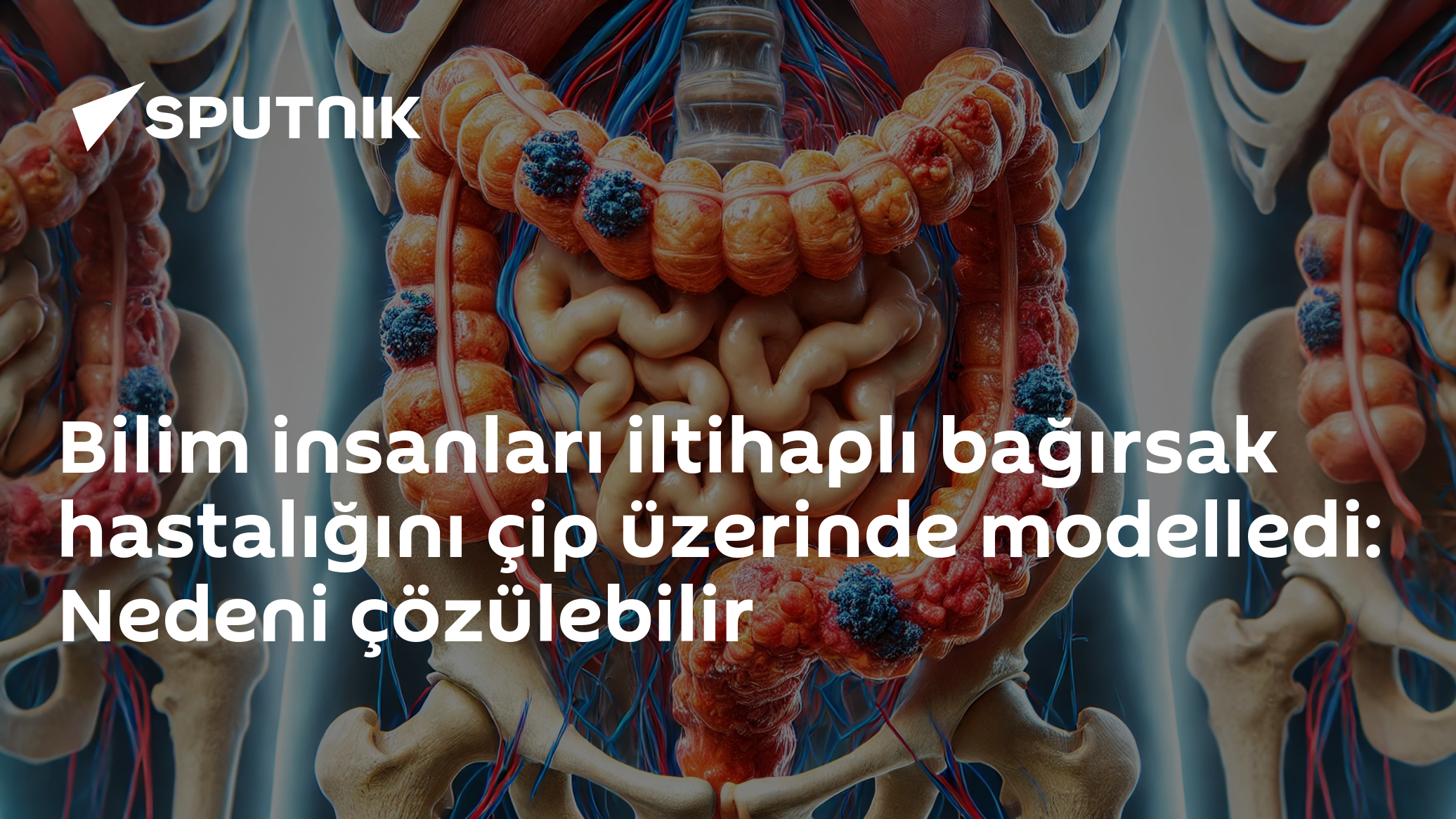 Bilim insanları iltihaplı bağırsak hastalığını çip üzerinde modelledi: Nedeni çözülebilir