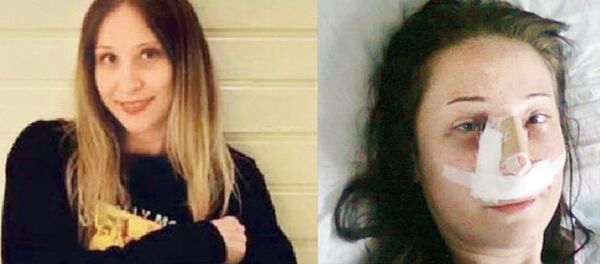 Burun ameliyatı sonrası iki bacağı da kesildi - Sputnik Türkiye