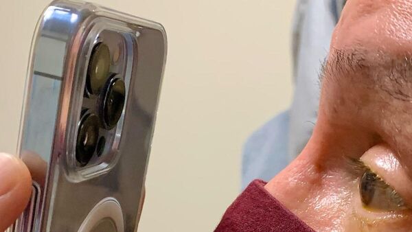 ABD'li doktor, göz tedavisi için iPhone 13 Pro Max kullanıyor - Sputnik Türkiye