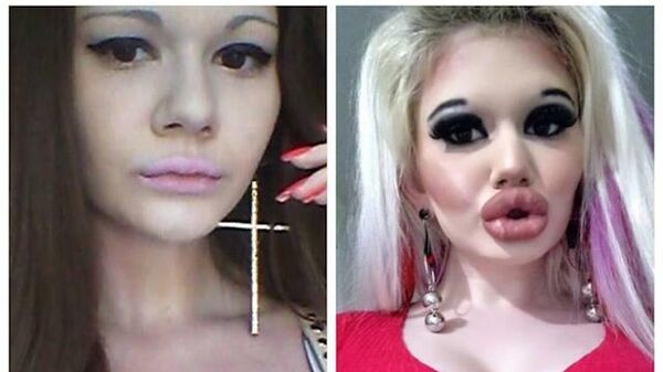 Bulgaristan'da yaşayan 24 yaşındaki Andrea Ivanova isimli kadın, Bratz bebekleri gibi görünmek için 26 kez estetik operasyon yaptırarak dudaklarını dolgunlaştırdı. Genç kadın, yılbaşı için yeniden estetik yaptırmayı planlıyor. - Sputnik Türkiye