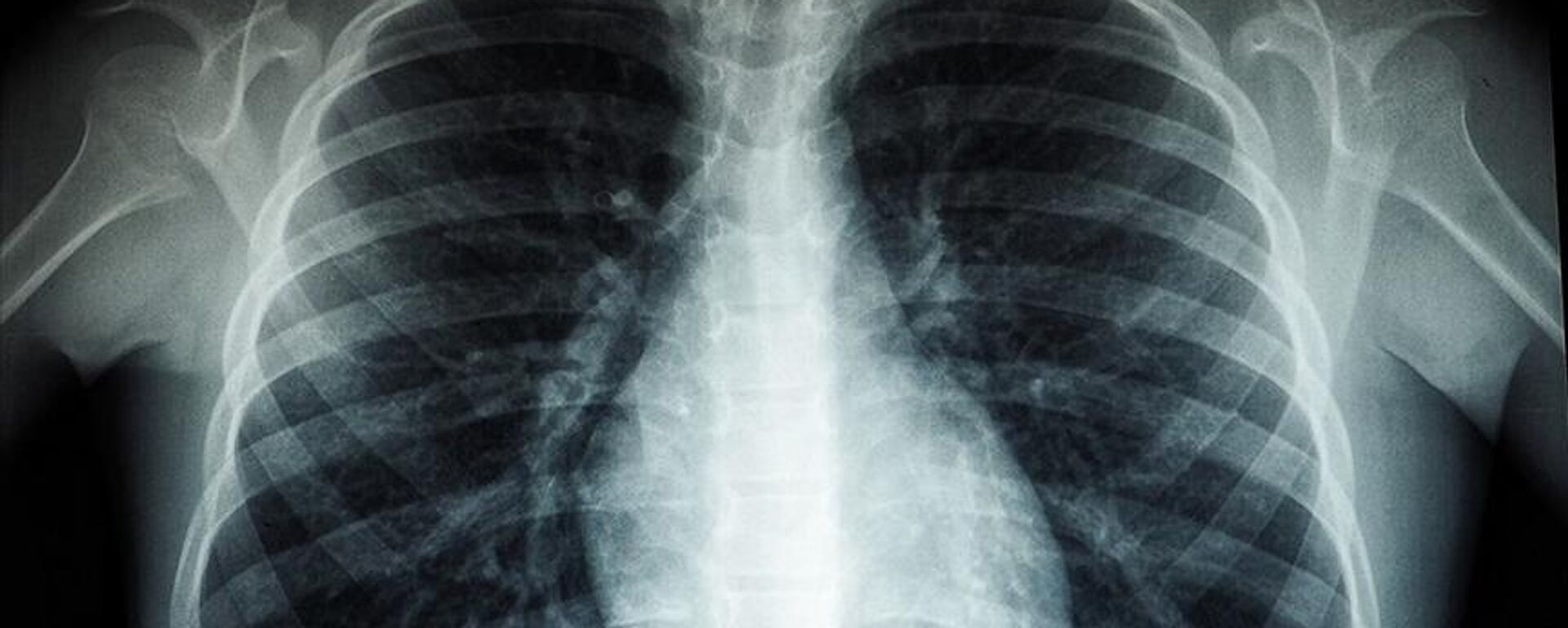 Akciğer röntgeni - Sputnik Türkiye, 1920, 26.08.2025