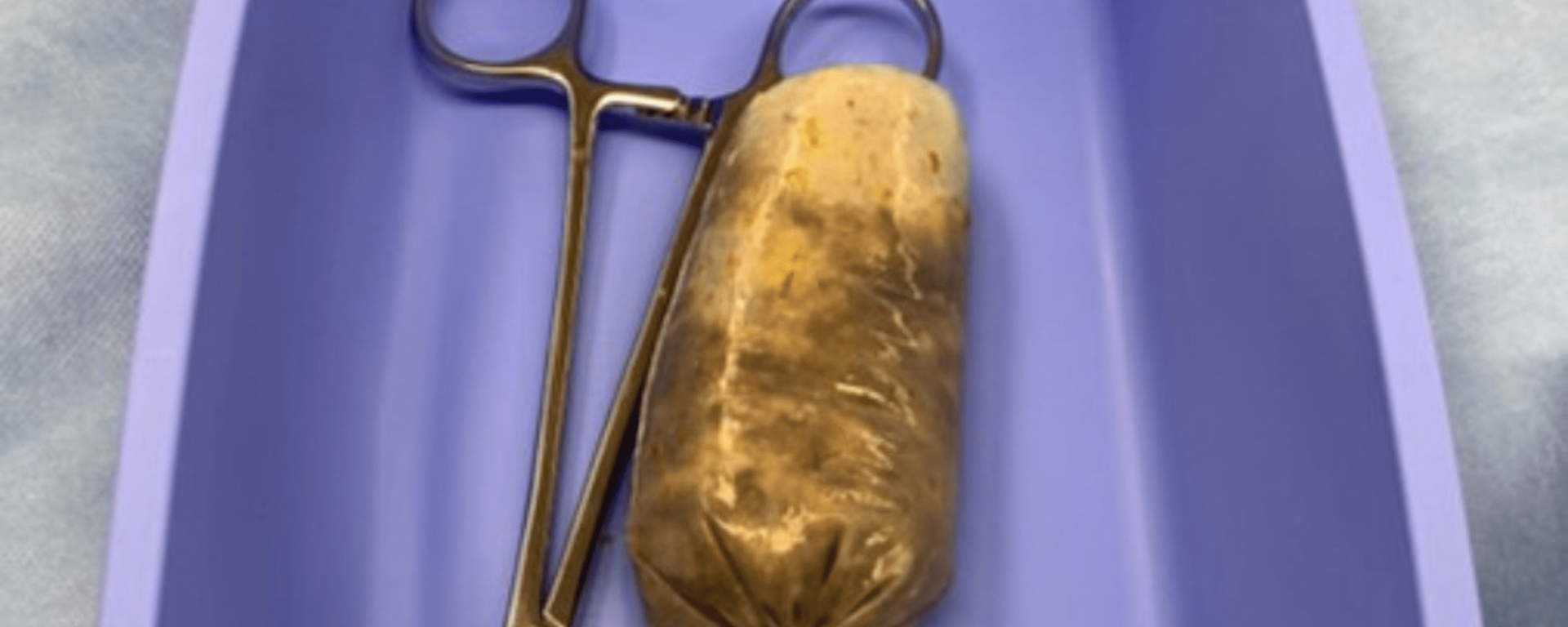 Acile başvuran adamın midesinden prezervatife doldurulmuş muz çıktı
 - Sputnik Türkiye, 1920, 29.01.2023