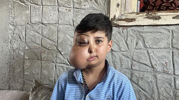 Yüzünün bir kısmının büyümesi durdurulamıyor: 'Doktorlar ameliyata yanaşmıyor' - Sputnik Türkiye