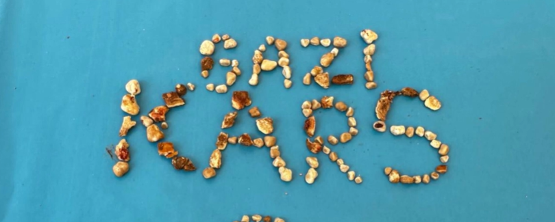 Kars'ta hastanın iki böbreğinden 300'ün üzerinde taş çıktı - Sputnik Türkiye, 1920, 24.05.2025