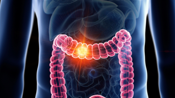 Kolon kanserinde umut verici klinik deney: Ölüm riski ciddi oranda azalıyor - Sputnik Türkiye