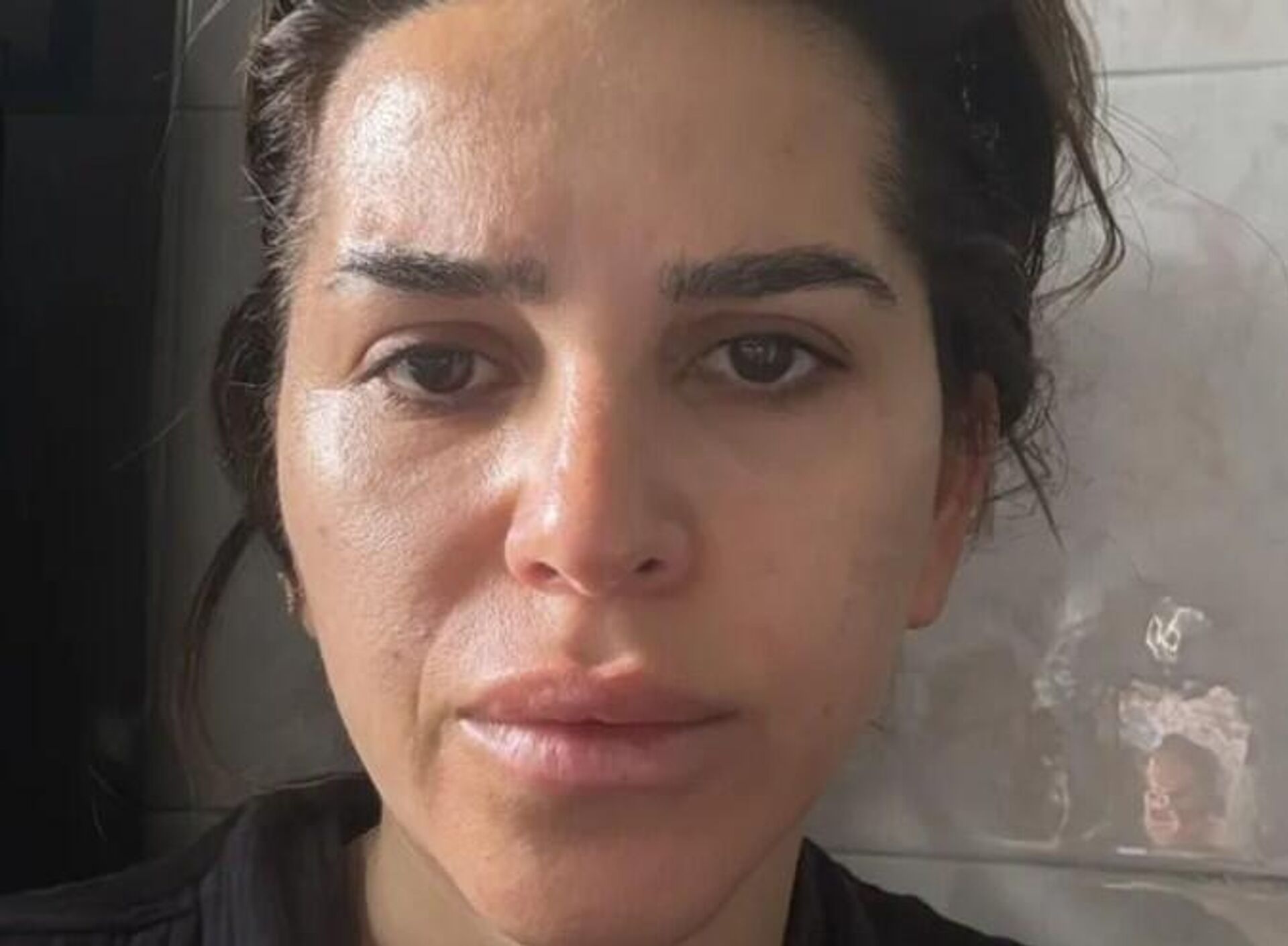 Gençlik aşısı yaptırdı, hayatı altüst oldu: Artık gülemiyor - Sputnik Türkiye, 1920, 08.06.2025