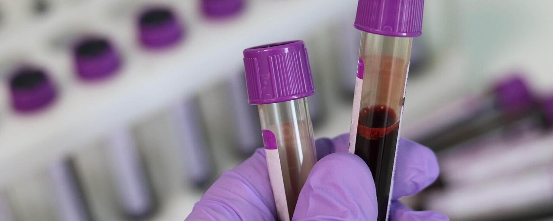 Bilim insanları sadece bir kişide görülen yeni bir kan grubu keşfetti: 'Gwada Negatif' - Sputnik Türkiye, 1920, 25.06.2025