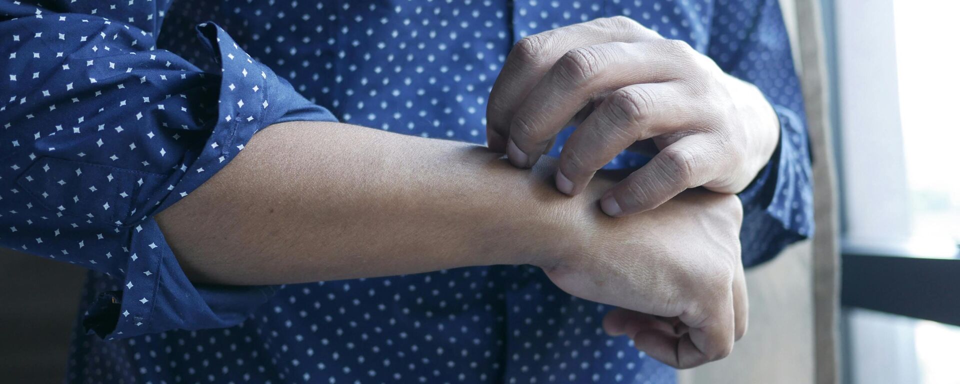 Basit bir kızarıklık sanılıyor: Tedavi edilmezse kalıcı damar sorunlarına yol açıyor - Sputnik Türkiye, 1920, 12.07.2025