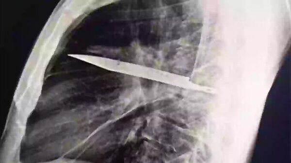 Tayvan'da hastaneye giden bir adam literatüre geçti: 8 yıldır göğsünde bıçakla yaşadığı ortaya çıktı - Sputnik Türkiye
