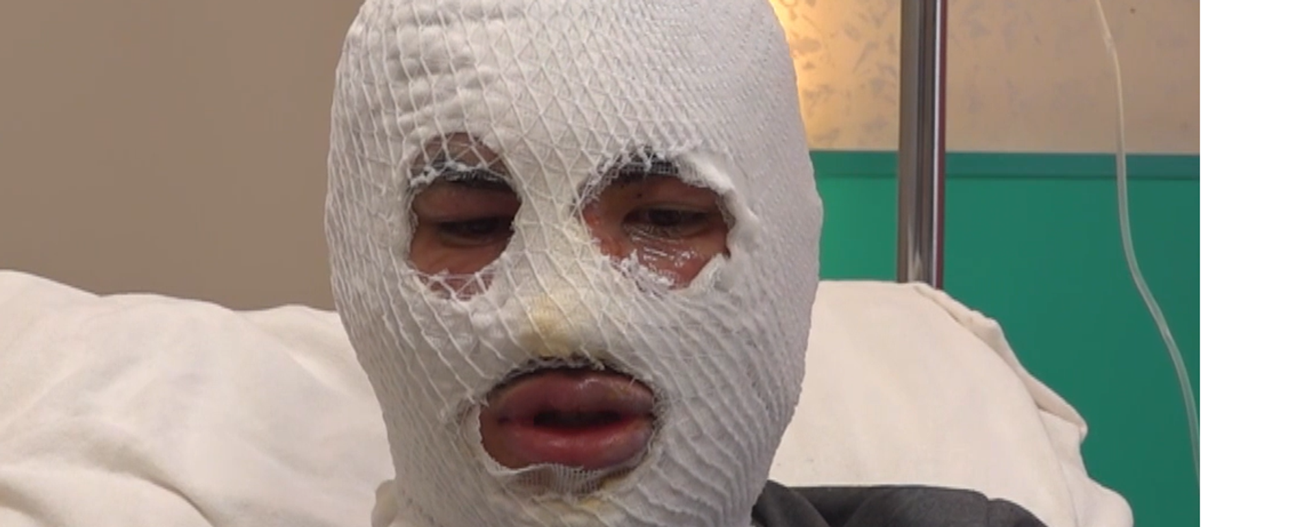 Çakmağına gaz doldurduğu tüp patladı, yüzü yandı: Kış olduğu için hemen yüzüme kar tuttum - Sputnik Türkiye, 1920, 20.02.2026