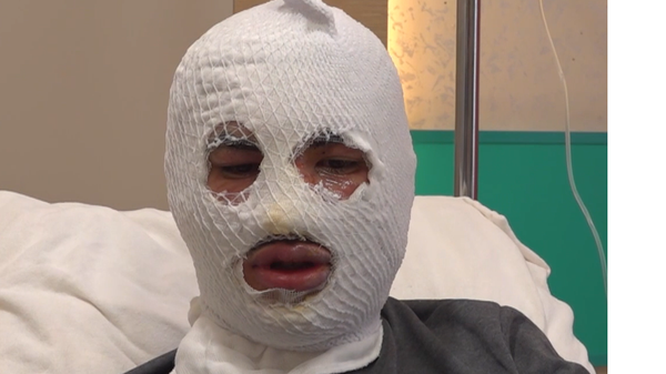 Çakmağına gaz doldurduğu tüp patladı, yüzü yandı: Kış olduğu için hemen yüzüme kar tuttum - Sputnik Türkiye