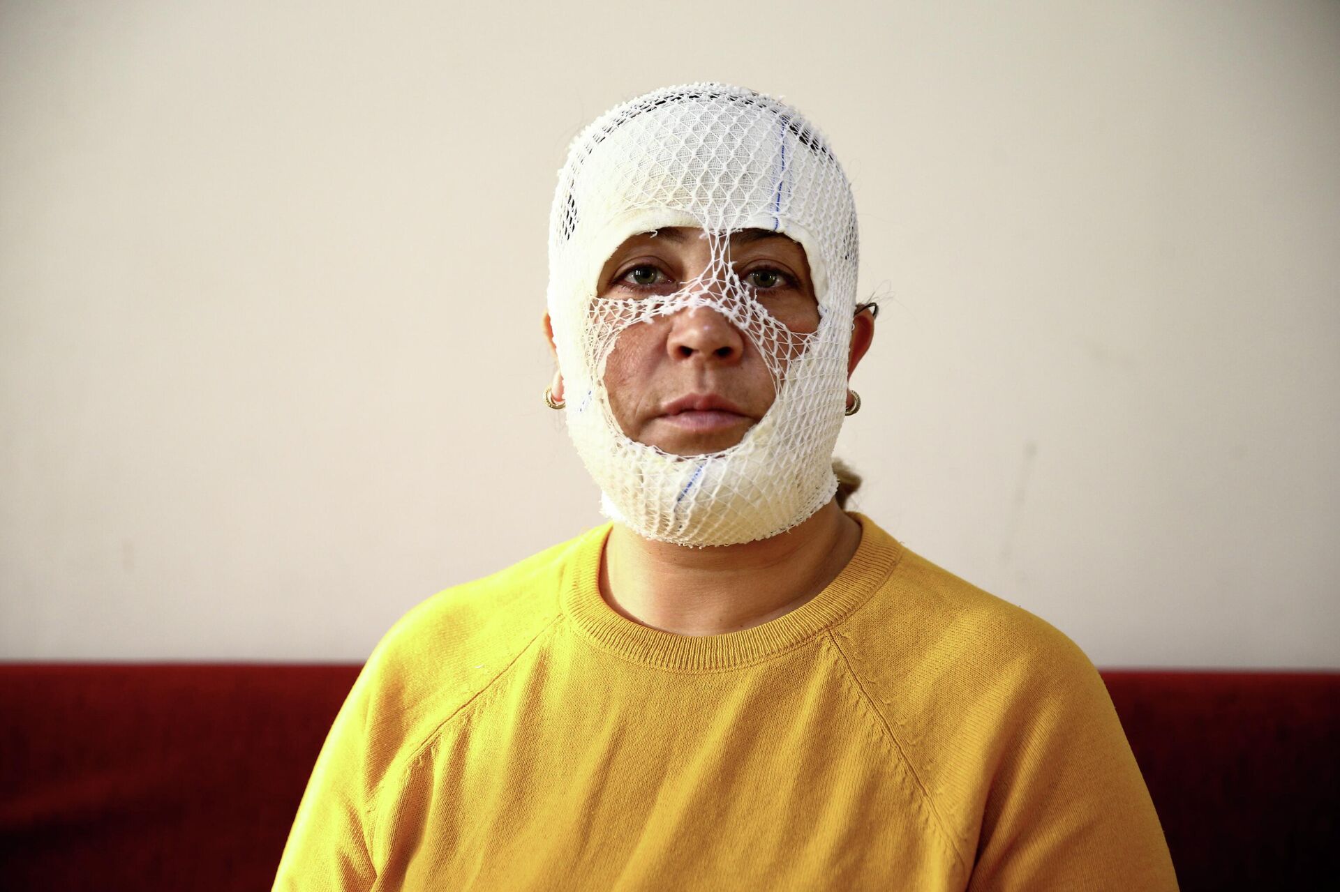  'Prenses bakım' yaptırdı yüzü yandı - Sputnik Türkiye, 1920, 22.04.2026