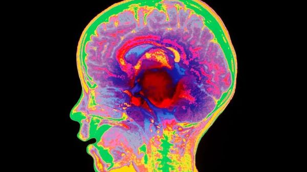 Glioma beyin kanseri olan bir çocuğun kafasının dikey bir kesitinin manyetik rezonans görüntüleme taraması (koyu kırmızı, merkezde)
 - Sputnik Türkiye