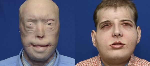 En kapsamlı yüz nakli Patrick Hardison En kapsamlı yüz nakli Patrick Hardison - Sputnik Türkiye