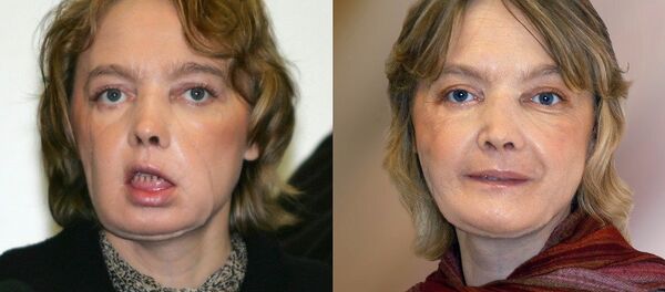 Isabelle Dinoire Isabelle Dinoire - Sputnik Türkiye