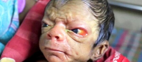 Yaşlı bebek-Benjamin Button-Bangladeş Yaşlı bebek-Benjamin Button-Bangladeş - Sputnik Türkiye
