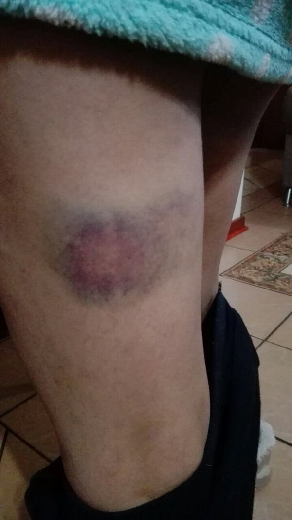 Zimbabve First Lady'si Grace Mugabe'nin kendisine saldırdığını iddia eden Gabriella Engels'in bacağında morluk görüldü. - Sputnik Türkiye