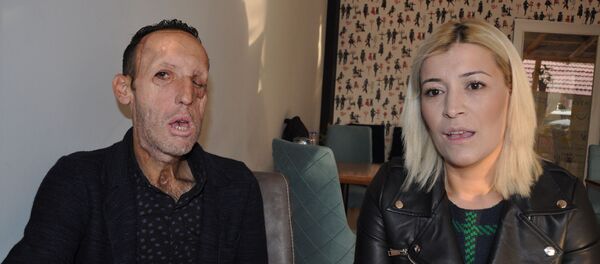 Türkiye'de yüz nakli yapılan 5. kişi olan Recep Sert - Sputnik Türkiye