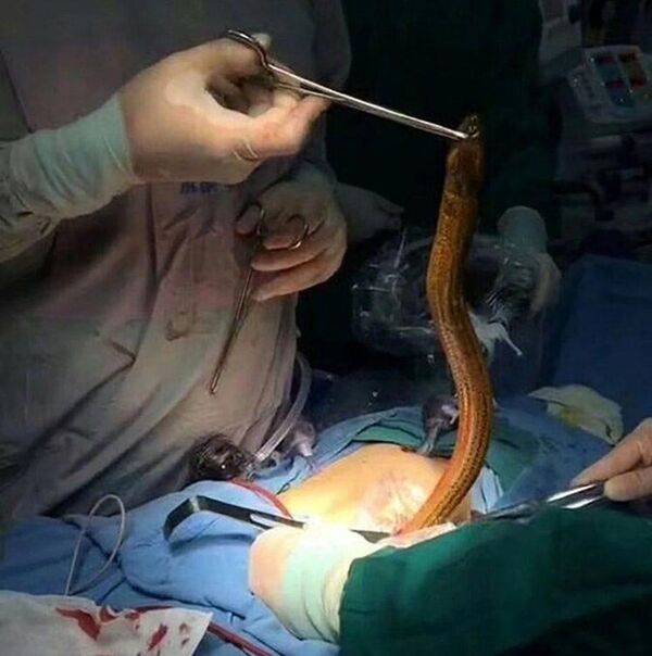 Anüsünden yılan balığı çıktı - Sputnik Türkiye