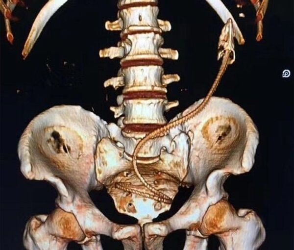 Anüsünden yılan balığı çıktı - Sputnik Türkiye