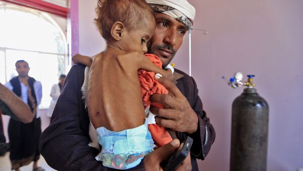 Başkent Sana'daki bir hastaneye yetersiz beslenmeden muzdarip çocuğunu getiren Yemenli bir baba - Sputnik Türkiye