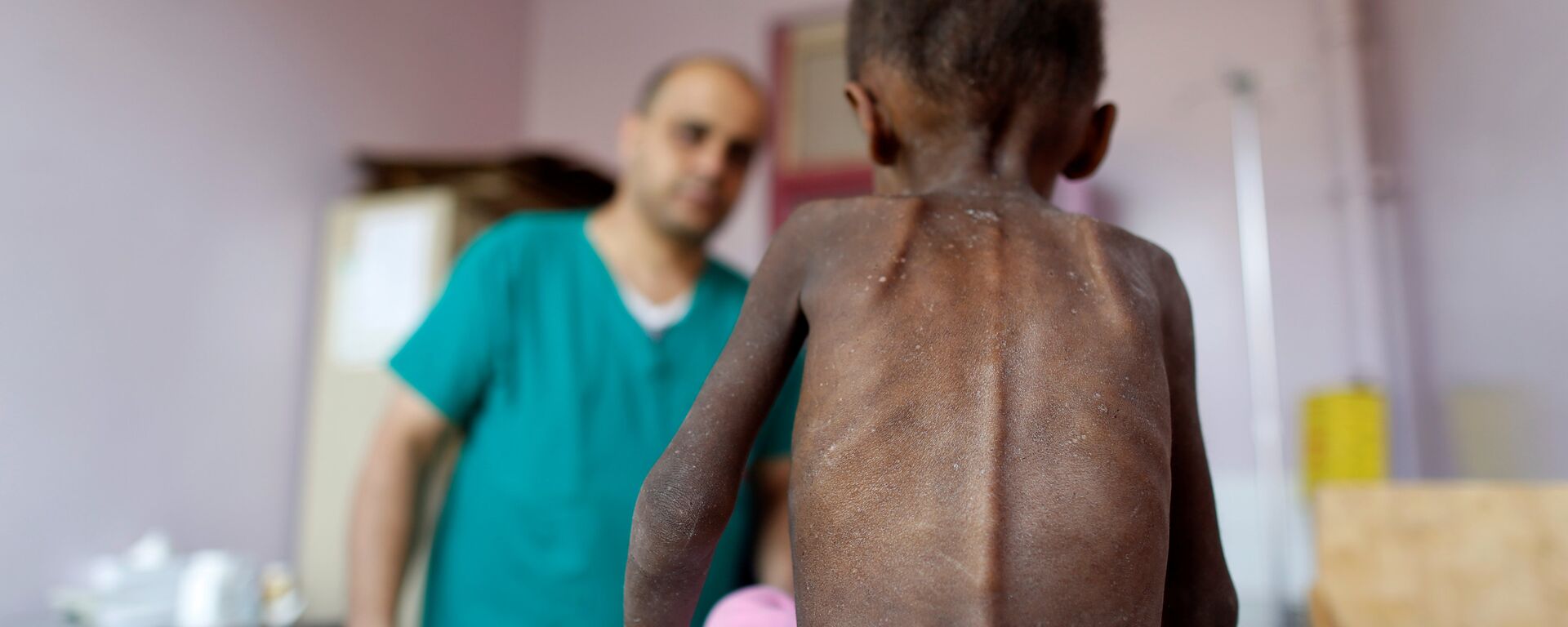 Yemen'de yetersiz beslenme nedeniyle sağlık sorunları yaşayan bir çocuk - Sputnik Türkiye, 1920, 14.04.2022