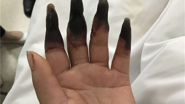 Elindeki ufak kesik nedeniyle 8 parmağını birden kaybediyordu - Sputnik Türkiye