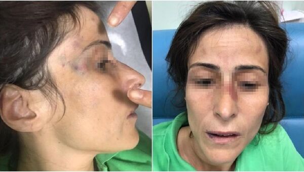 Eşinin kemiklerini kıran doktora 'takdir indirimi' - Sputnik Türkiye