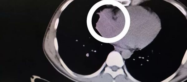 Alkol alırken yuttuğu kürdan kalbine saplandı - Sputnik Türkiye