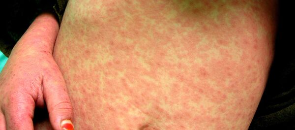 Health officials across the country have been concerned about the spread of measles as dozens were diagnosed with the disease due to anti-vaccination movements. - Sputnik Türkiye