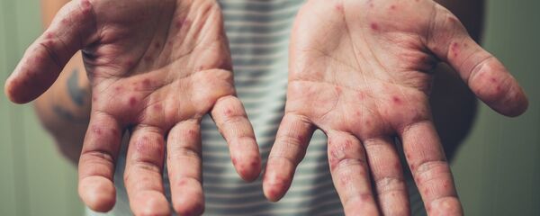 Kızamık - Sputnik Türkiye