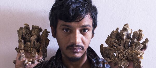 Bangladeş’te 10 yaşından beri ‘ağaç adam sendromundan’ mustarip olan Abul Bajandar - Sputnik Türkiye