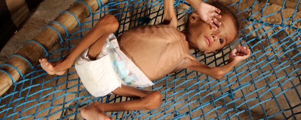 Yemen'de açlık ve yetersiz beslenme Yemen'de açlık ve yetersiz beslenme - Sputnik Türkiye