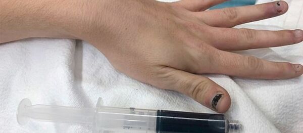 25 yaşındaki kadının kanı, içtiği ilaç yüzünden mavi renge döndü - Sputnik Türkiye