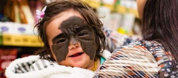 Batman maskesini andıran bir doğum lekesine sahip minik kızın tedavisi Rusya’da başladı - Sputnik Türkiye