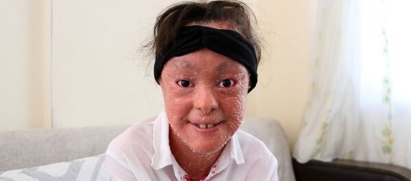 Balık pulu hastası Medine - Sputnik Türkiye