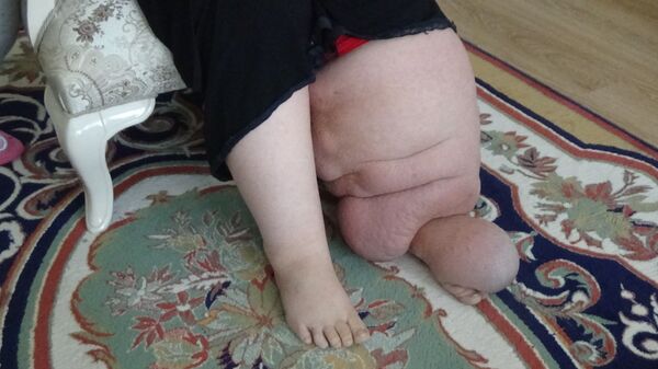 Fil hastalığına yakalanan Ayşe yardım bekliyor - Sputnik Türkiye