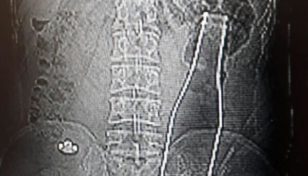 Karın ağrısı şikayetiyle gittiği hastanede, vücudunda şişe olduğu ortaya çıktı - Sputnik Türkiye