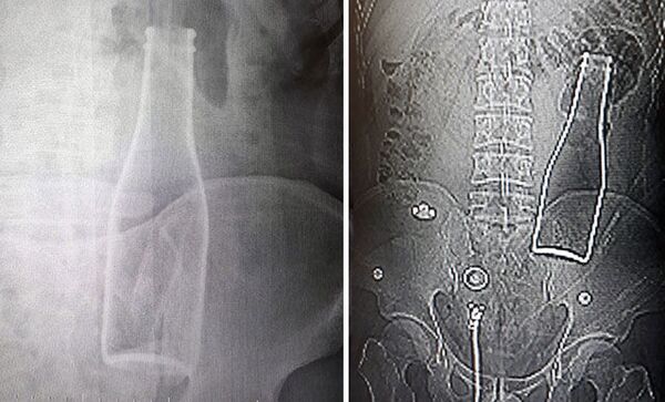Karın ağrısı şikayetiyle gittiği hastanede, vücudunda şişe olduğu ortaya çıktı - Sputnik Türkiye